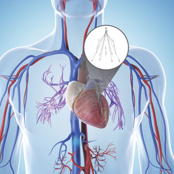 IVC Filter Placement Services in Houston - Synergy Vascular