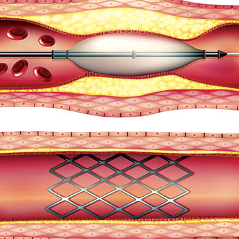 arteriogram angioplasty and stenting