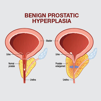 Prostate Artery Embolization - Houston - Synergy Vascular and Interventional