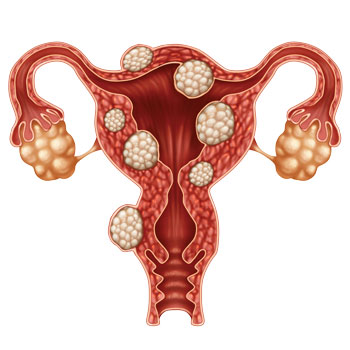 UFE - Uterine Fibroid Embolization - Houston - Synergy Vascular